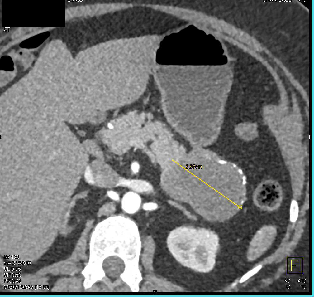 Solid and Papillary Epithelial Neoplasm (SPEN) Tail of Pancreas - CTisus CT Scan