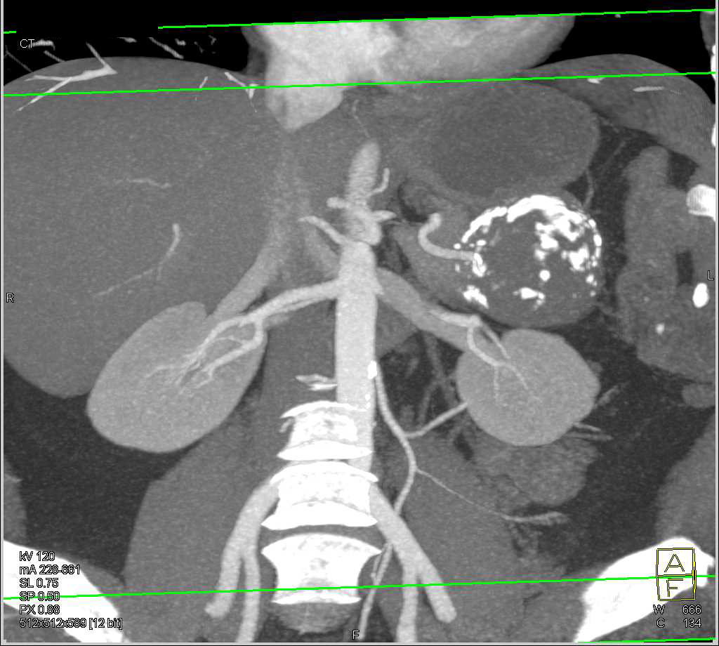 Solid and Papillary Epithelial Neoplasm (SPEN) Tail of the Pancreas - CTisus CT Scan