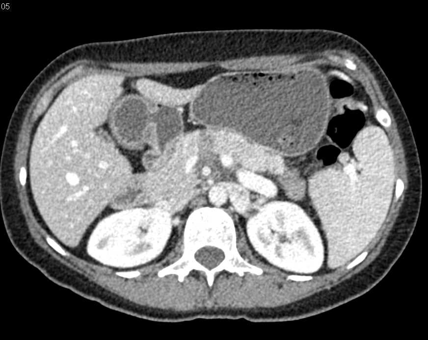 Carcinoma Body of the Pancreas with Arterial Invasion - CTisus CT Scan