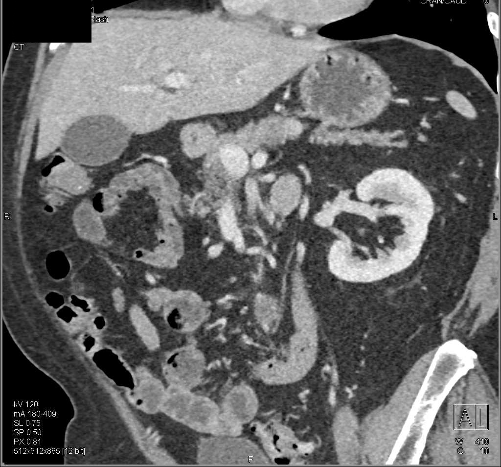 1 cm Pancreatic Neuroendocrine Tumor (PNET) in the body of the Pancreas - CTisus CT Scan