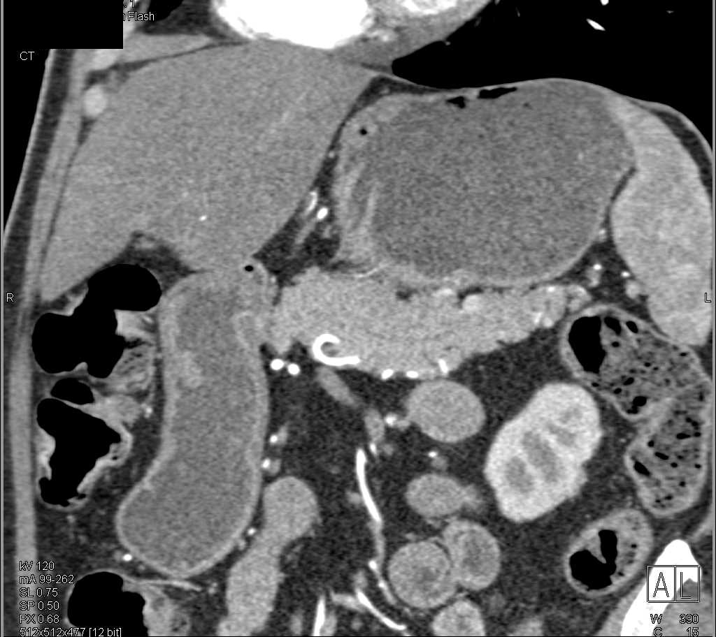 Small Neuroendocrine Tumor of the Pancreas - CTisus CT Scan