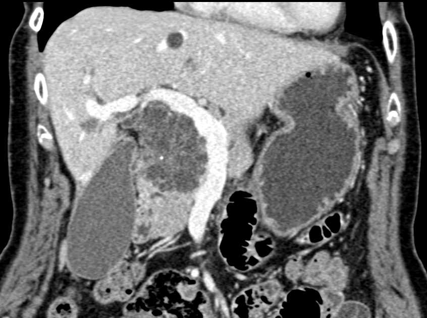 Serous Cystadenoma Head of Pancreas - CTisus CT Scan