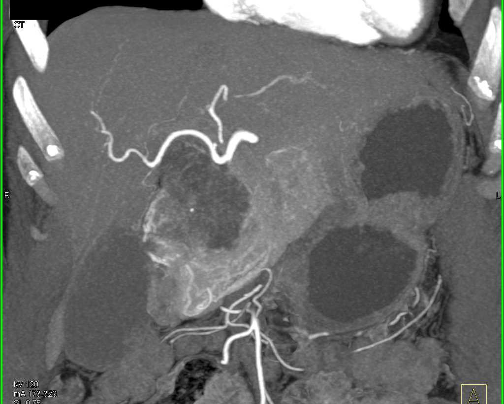 Serous Cystadenoma Head of Pancreas - CTisus CT Scan