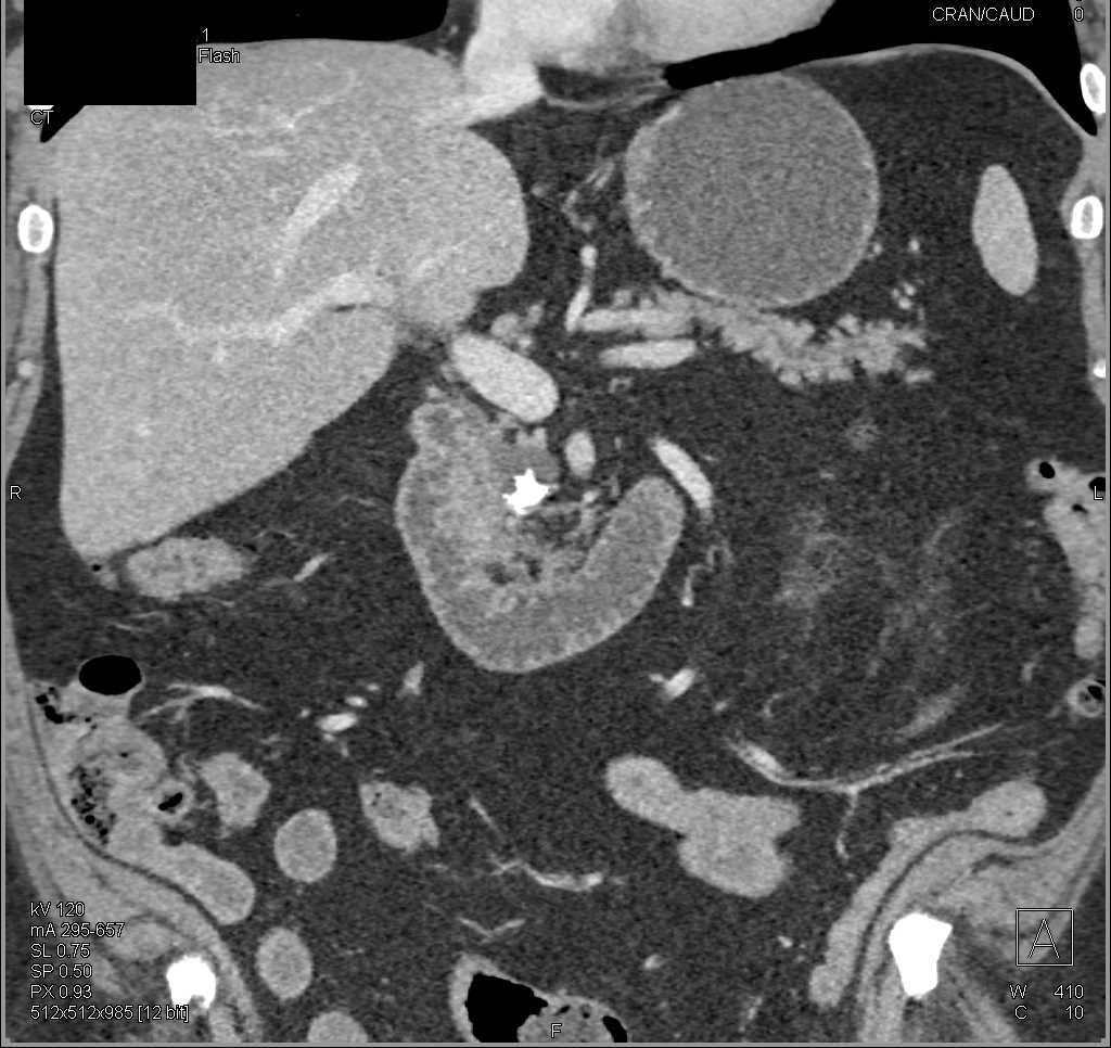 Chronic Pancreatitis Head of the Pancreas - CTisus CT Scan