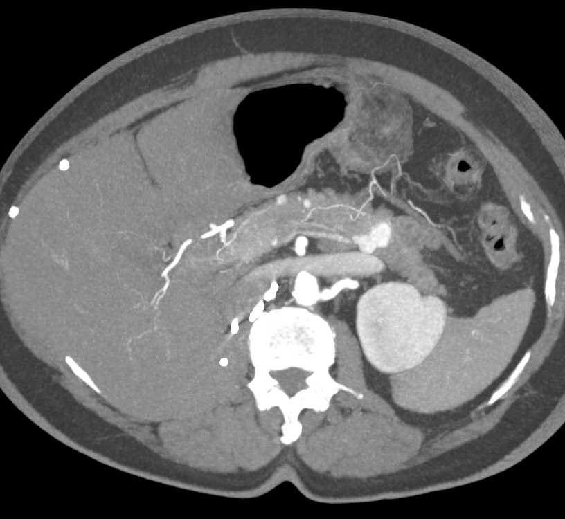Metastatic Renal Cell Carcinoma to the Pancreas - CTisus CT Scan