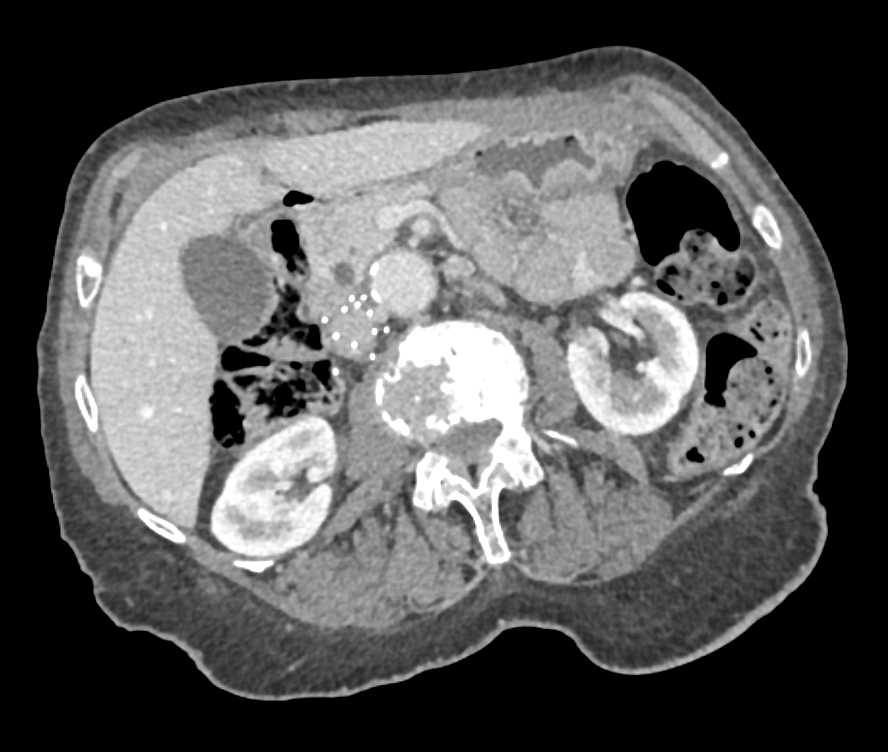 Neuroendocrine Tumor in the Tail of the Pancreas - CTisus CT Scan