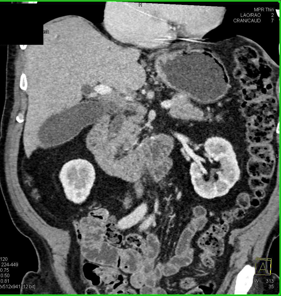 Pancreatic Adenocarcinoma with Main Duct Intraductal Papillary Mucinous Neoplasm (IPMN) - CTisus CT Scan