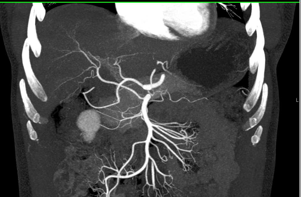 Multiple Pancreatic Intraductal Papillary Mucinous Neoplasms (IPMNs) - CTisus CT Scan