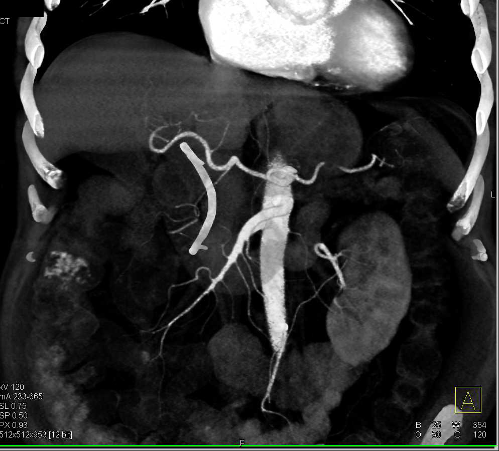 Pancreatic Mass Encases Superior Mesenteric Artery (SMA) and Superior Mesenteric Vein (SMV). - CTisus CT Scan