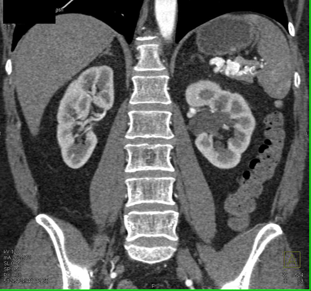 Neuroendocrine Tumor Pancreas - CTisus CT Scan