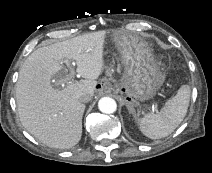 Pancreatic Necrosis with Abscess - CTisus CT Scan