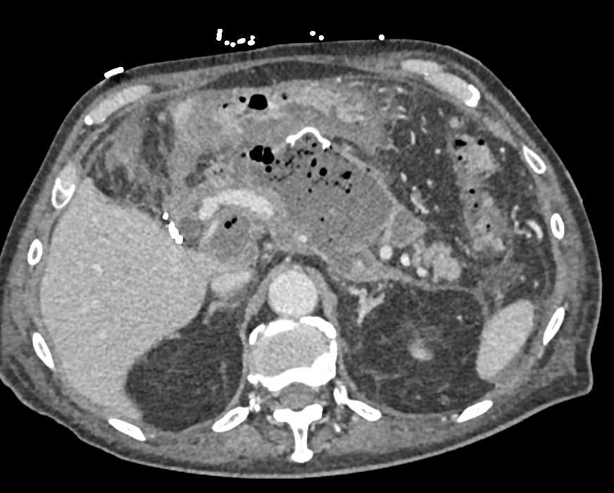 Pancreatic Abscess Ultrasound