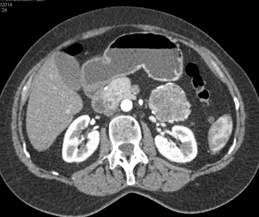 Serous Cystadenoma Tail of Pancreas with Dilated Distal Duct - CTisus CT Scan