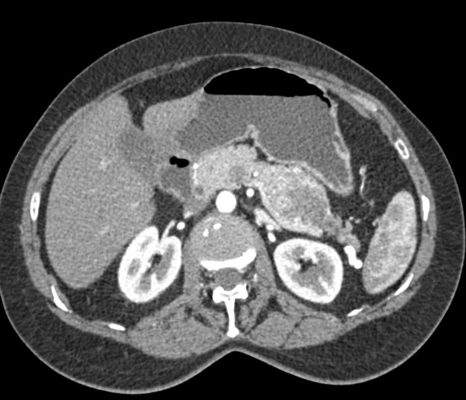 Serous Cystadenoma Tail of Pancreas with Dilated Distal Duct - CTisus CT Scan