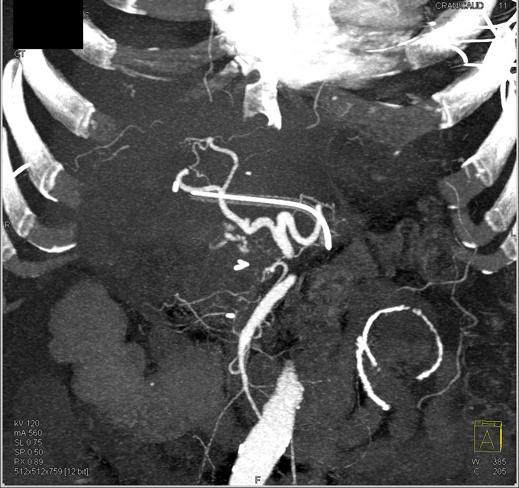 Hepatic Artery Bleed s/p Whipple Procedure - CTisus CT Scan