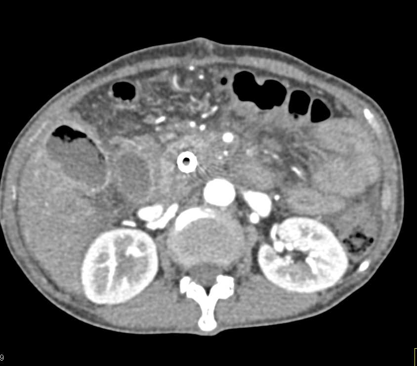 Pancreatic Cancer with Infiltrating Tumor and Adenopathy - CTisus CT Scan