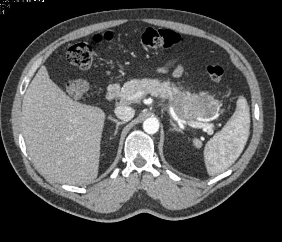 Carcinoma of the Tail of the Pancreas - CTisus CT Scan