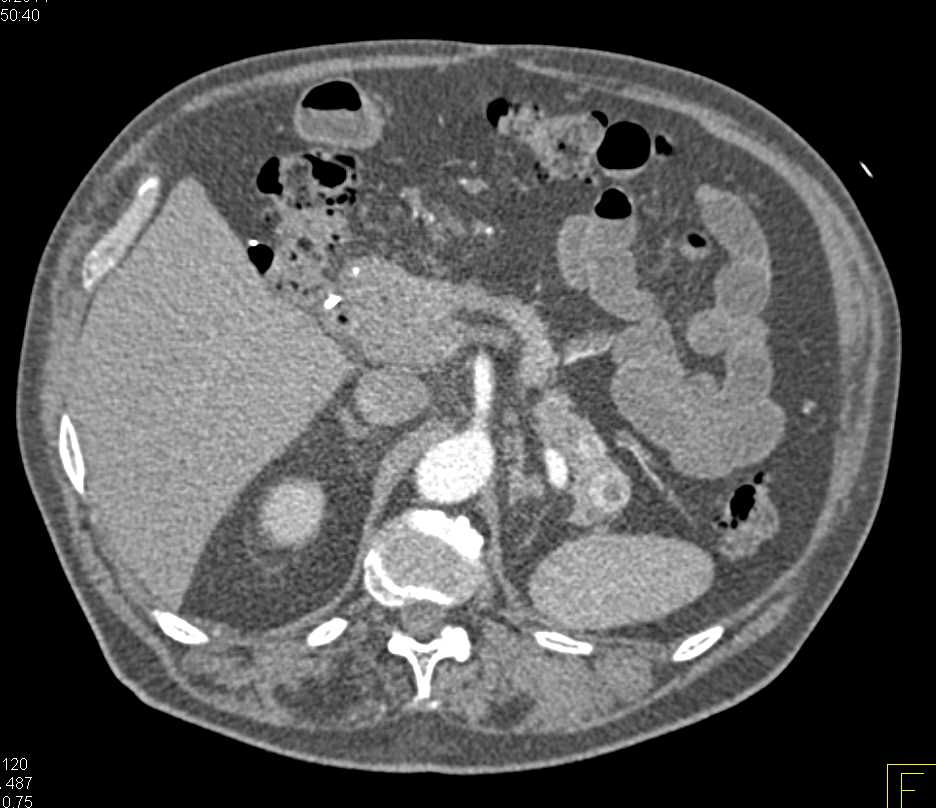 Metastatic Renal Cell Carcinoma to the Pancreas - CTisus CT Scan