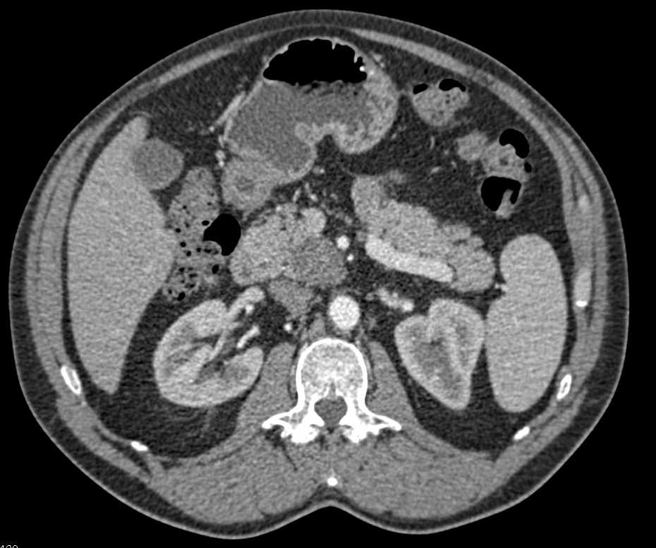 Intraductal Papillary Mucinous Neoplasm (IPMN) in Head of the Pancreas - CTisus CT Scan