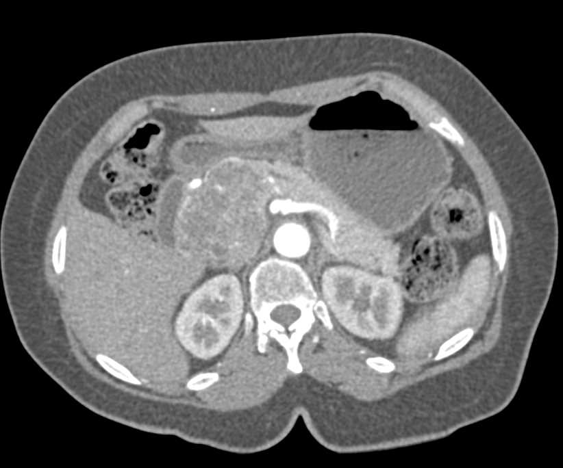 Serous Cystadenoma Head of Pancreas - CTisus CT Scan