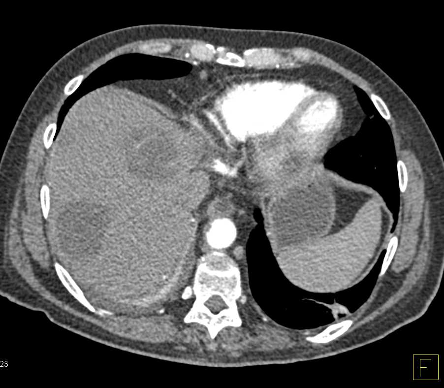 Pancreatic Cancer with Liver Metastases and Incidental Pericardial Cyst - CTisus CT Scan