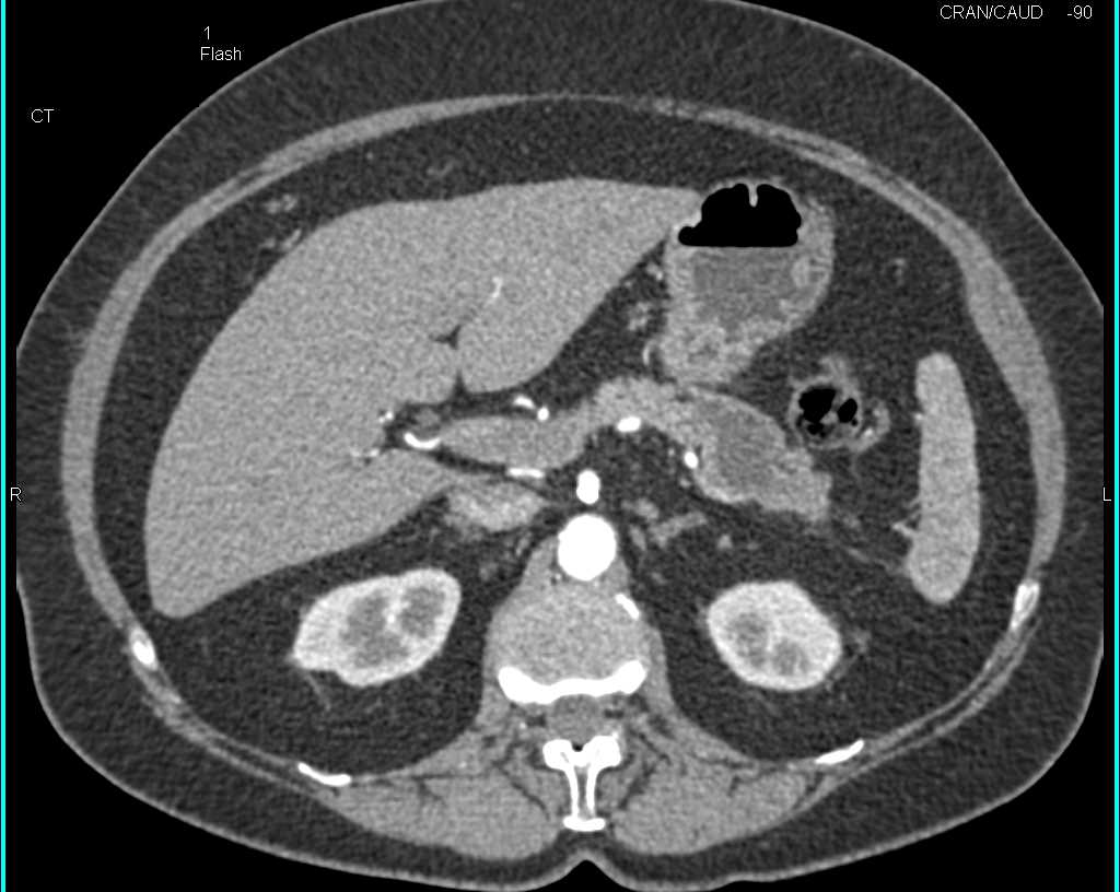 Main Duct Intraductal Papillary Mucinous Neoplasm (IPMN) with High Grade Dysplasia - CTisus CT Scan