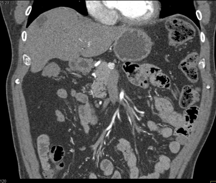 Neuroendocrine Tumor 1 cm in Head of the Pancreas - CTisus CT Scan