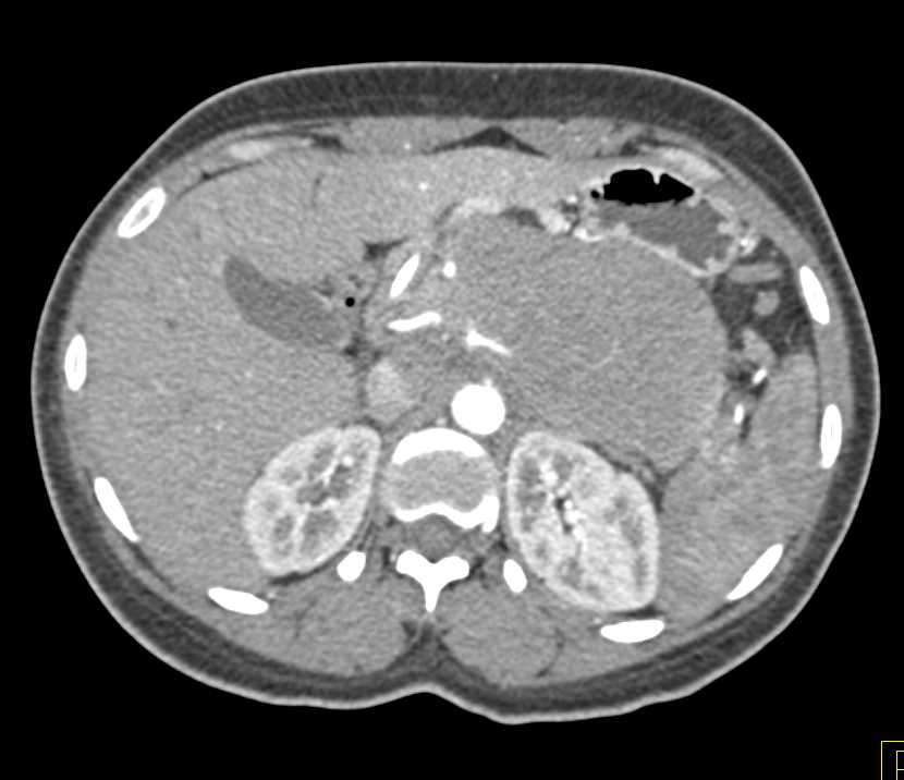 Neuroendocrine Tumor in Tail of the Pancreas - CTisus CT Scan