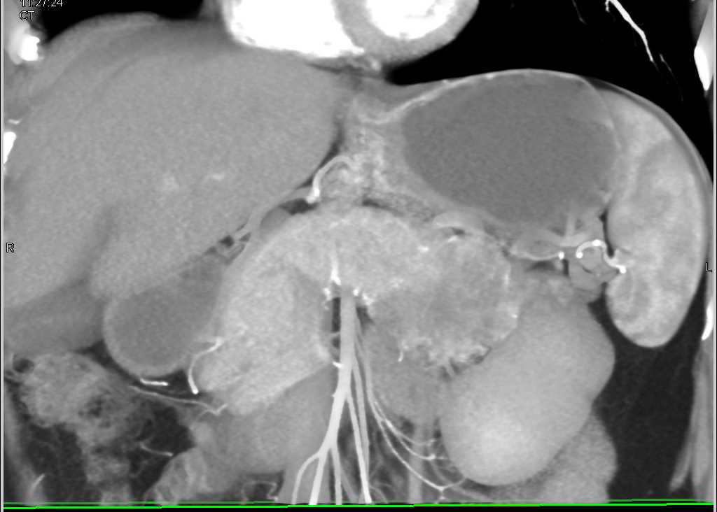 Solid and Papillary Epithelial Neoplasm (SPEN) Tumor in the Tail of the Pancreas - CTisus CT Scan