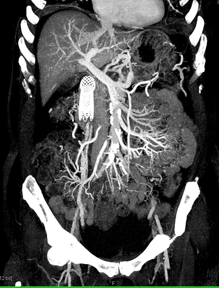 Pancreatic Cancer Metastatic to the Ovary - CTisus CT Scan