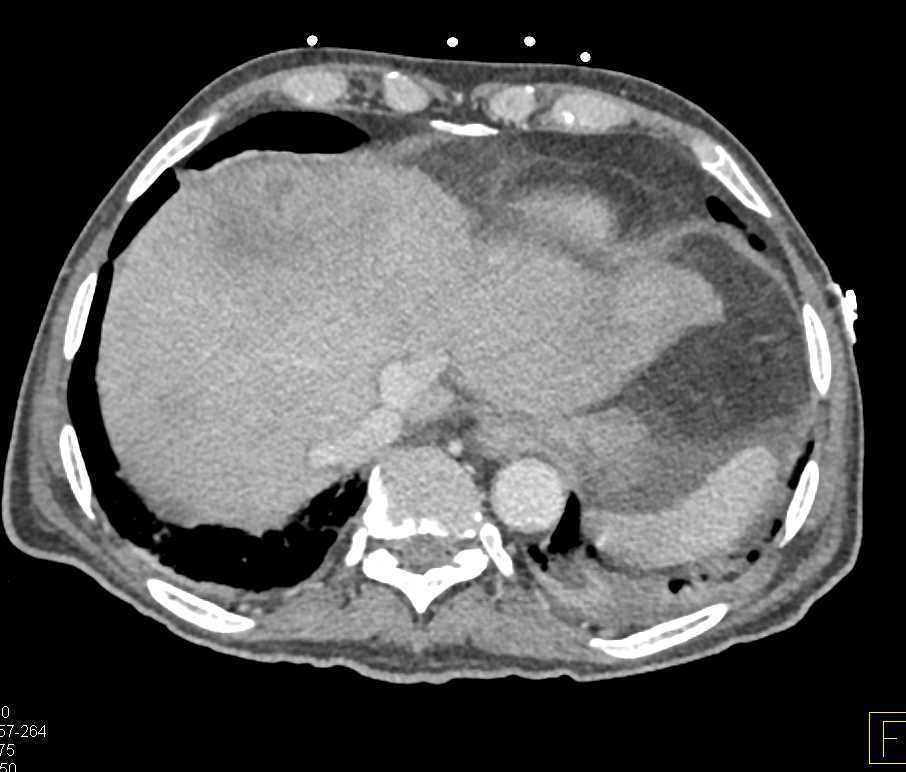 Pancreatic Cancer with Liver Metastases - CTisus CT Scan