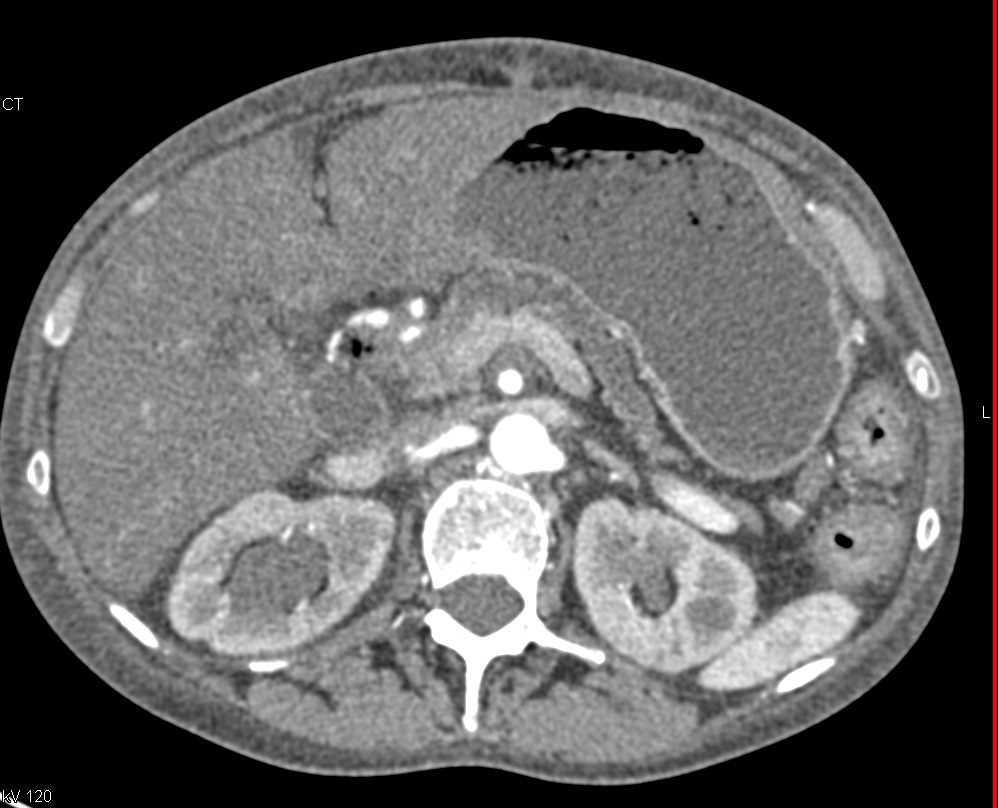Pancreatic Cancer with Vascular Infiltration - CTisus CT Scan