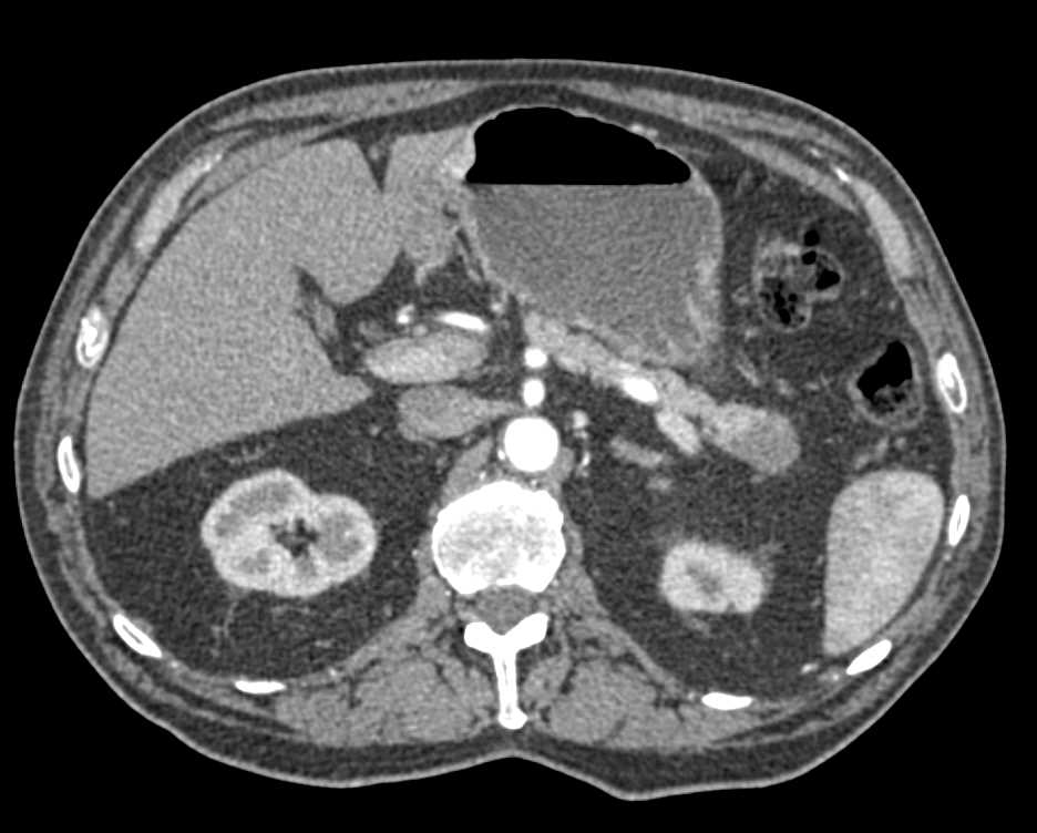 Carcinoma of the Tail of the Pancreas - CTisus CT Scan