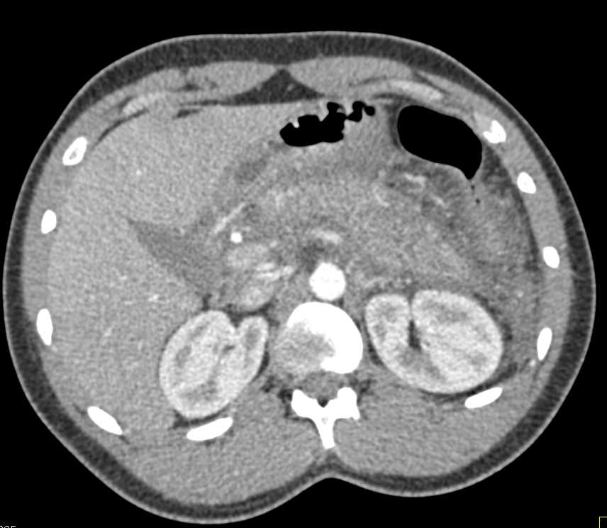 Acute Pancreatitis with Periglandular Necrosis - CTisus CT Scan