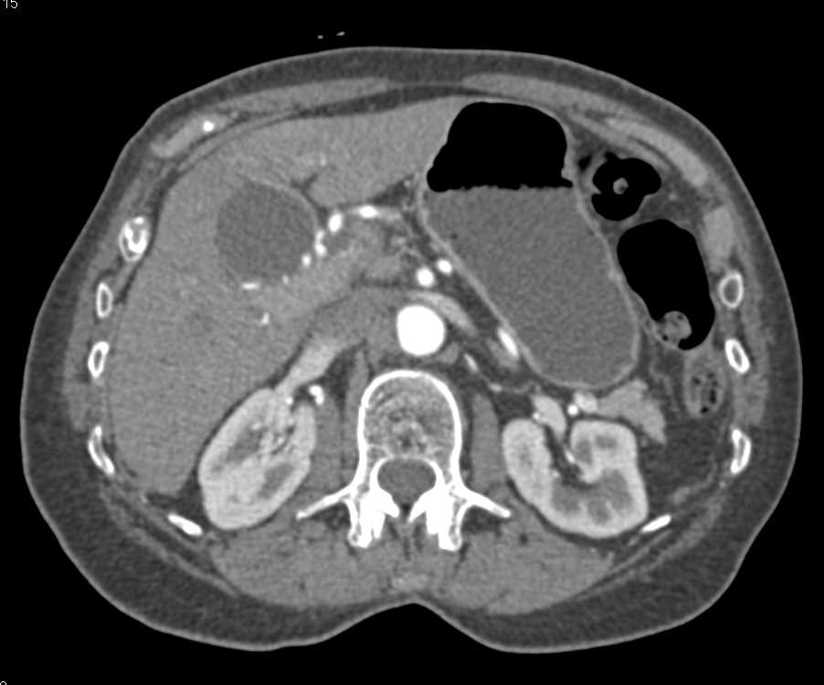 Gallbladder Cancer with Near Perihilar Adenopathy - CTisus CT Scan