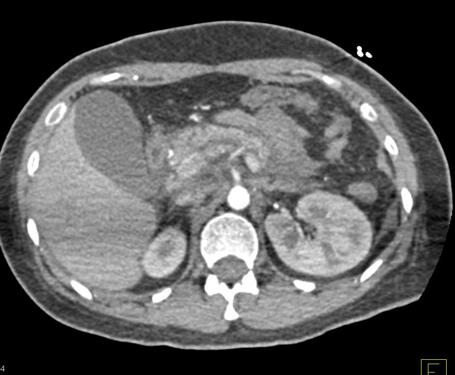 Acute Pancreatitis and Duodenitis - CTisus CT Scan