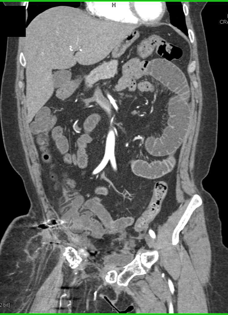 Intraductal Papillary Mucinous Neoplasm (IPMN) Head of the Pancreas - CTisus CT Scan