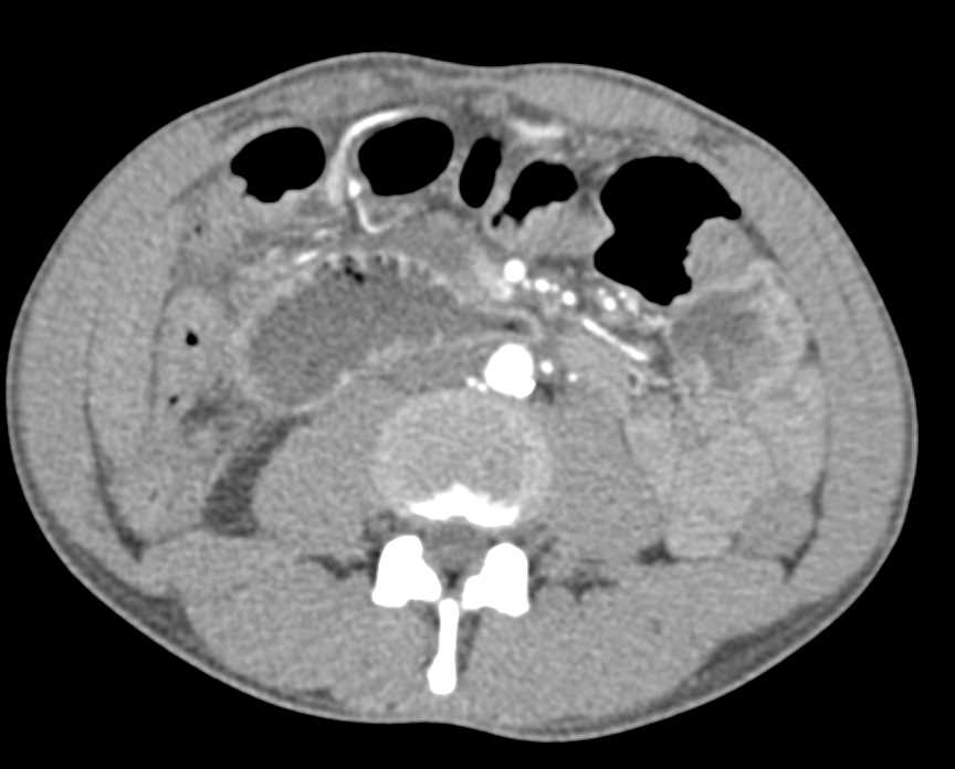 Infiltrating Pancreatic Adenocarcinoma with Arterial and Venous Invasion and Duodenal Obstruction - CTisus CT Scan