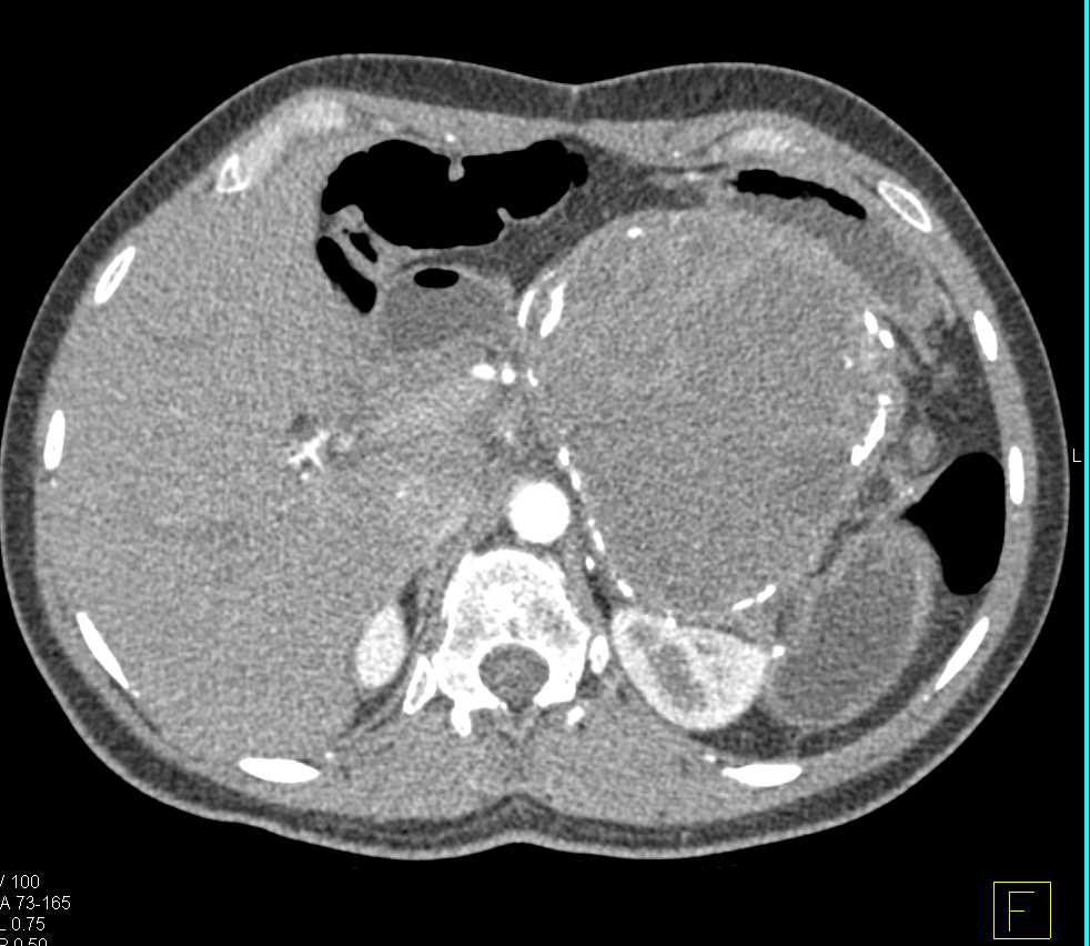 Solid and Papillary Epithelial Neoplasm (SPEN) Tumor Tail of the Pancreas - CTisus CT Scan