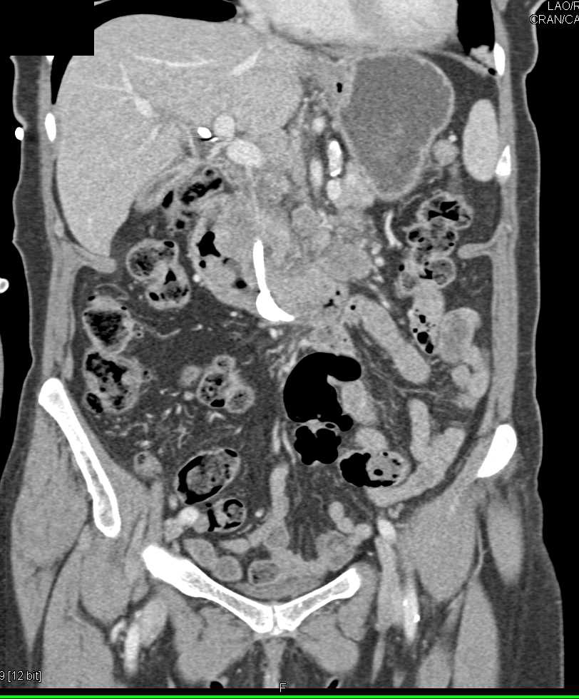 Pancreatic Cancer Invades the Duodenum - CTisus CT Scan