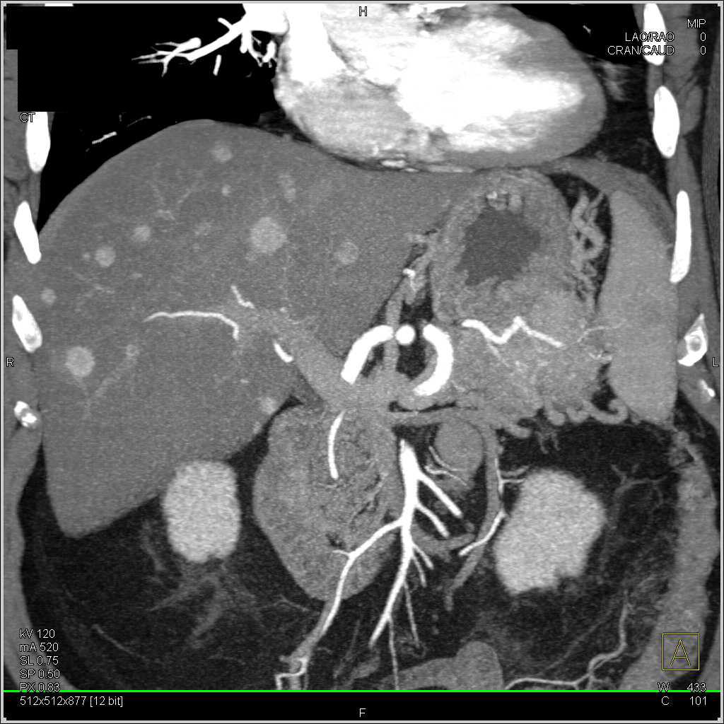 Neuroendocrine Tumor Tail of Pancreas with Liver Metastases - CTisus CT Scan