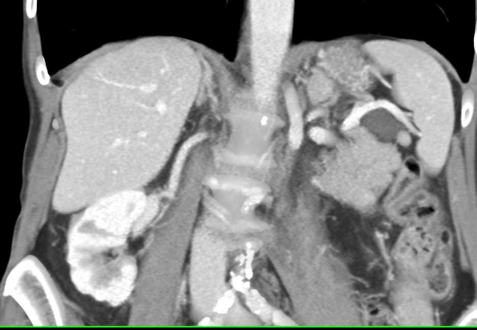 Intraductal Papillary Mucinous Neoplasm (IPMN) Tail of the Pancreas - CTisus CT Scan