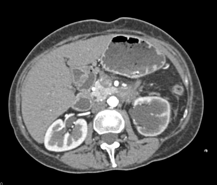 Carcinoma Tail of the Pancreas - CTisus CT Scan