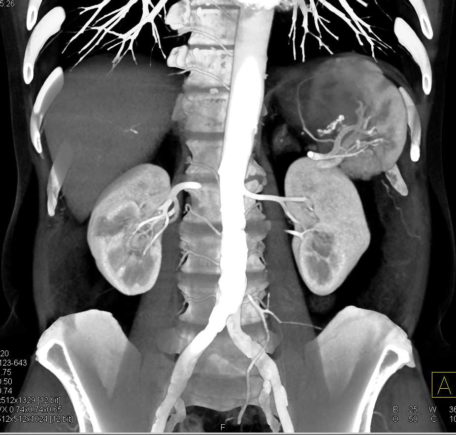 Pseudocyst Tail of the Pancreas - CTisus CT Scan