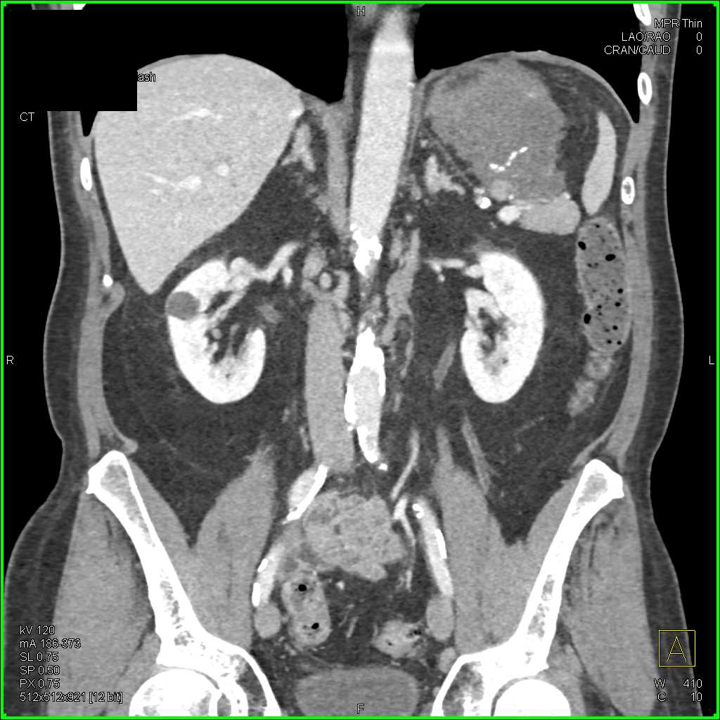 Pseudocyst Tail of the Pancreas - CTisus CT Scan