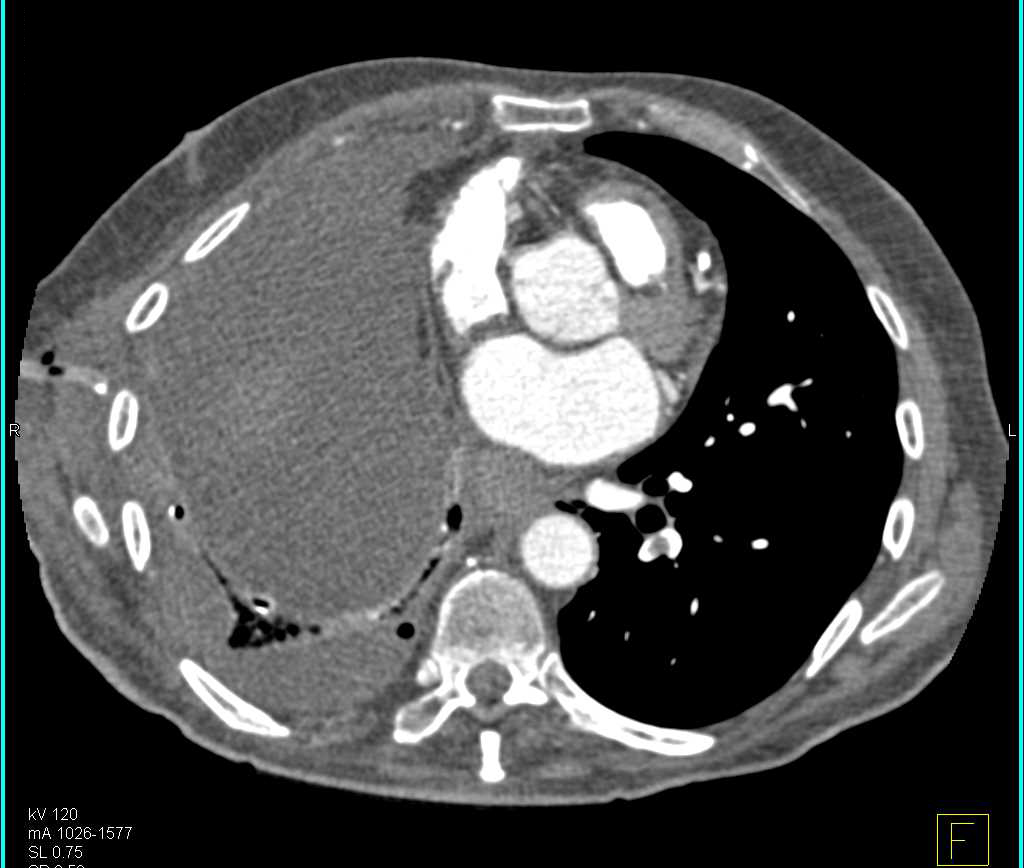 Neuroendocrine Tumor in the Head of the Pancreas - CTisus CT Scan