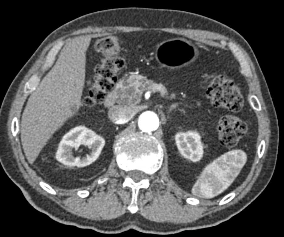 Multiple Intraductal Papillary Mucinous Neoplasms (IPMNs) in the Pancreas - CTisus CT Scan