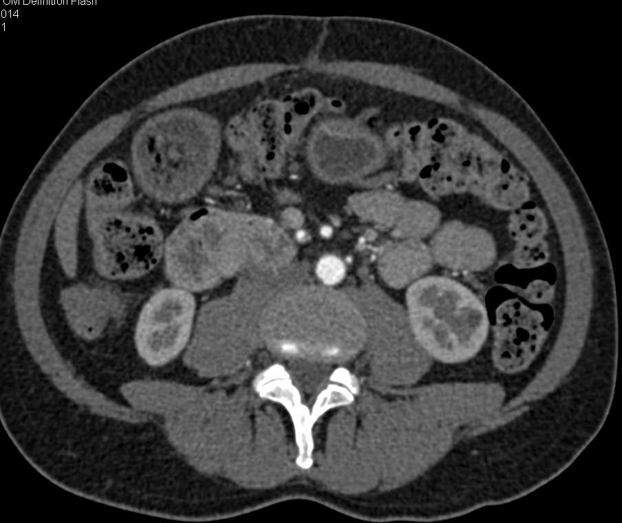 Pancreatic Cancer and Celiac Artery Dissection - CTisus CT Scan