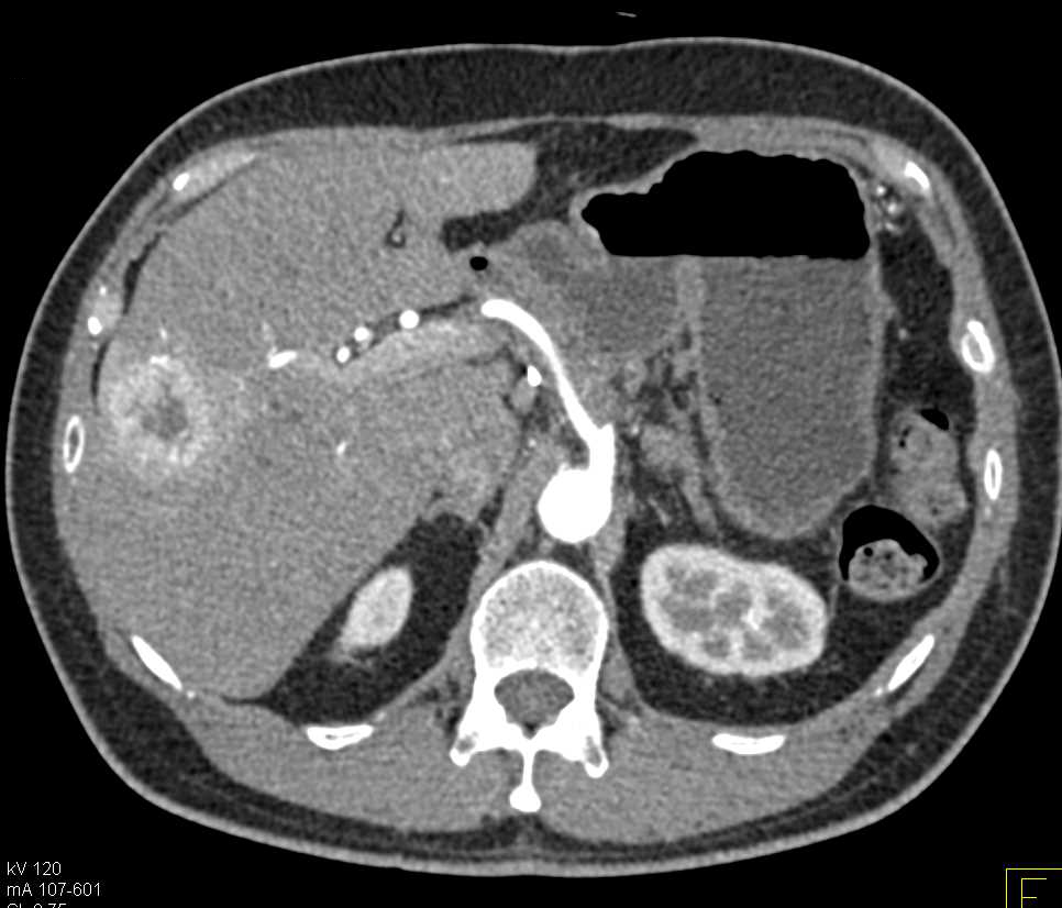 Neuroendocrine Tumor Pancreas - Pancreas Case Studies - CTisus CT Scanning