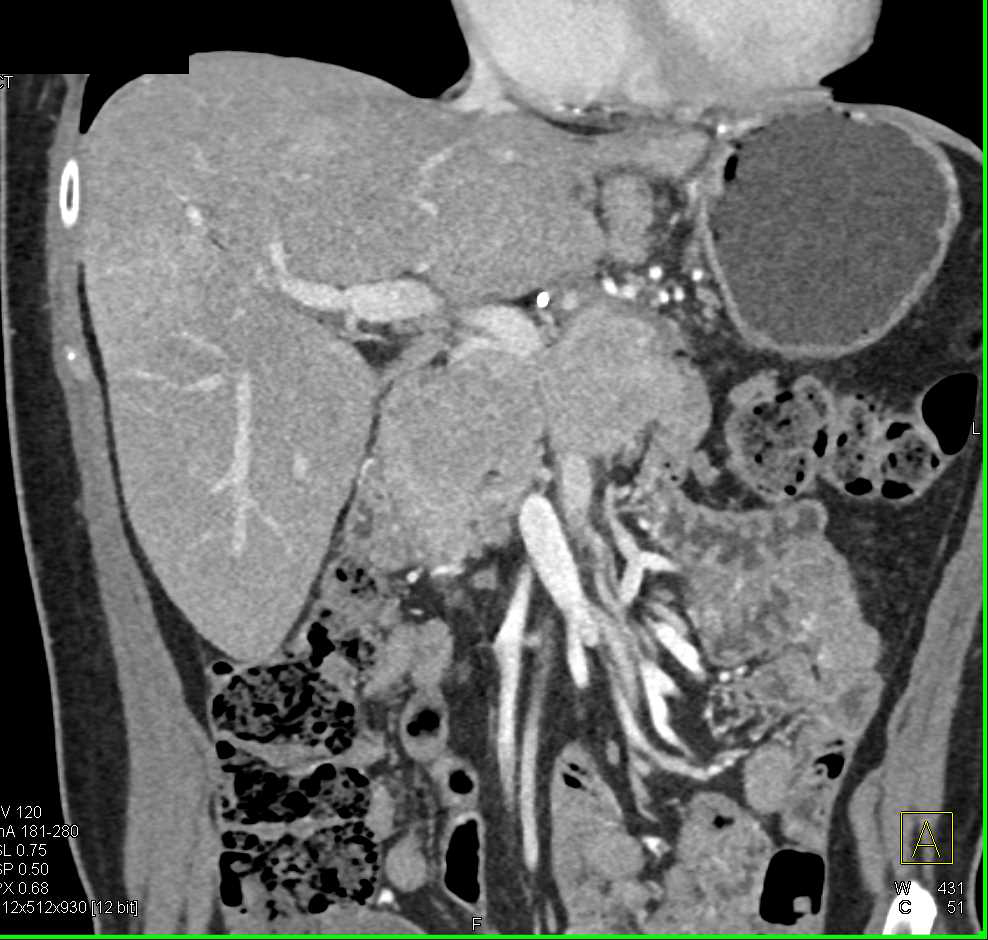 Neuroendocrine Tumor Pancreas - CTisus CT Scan